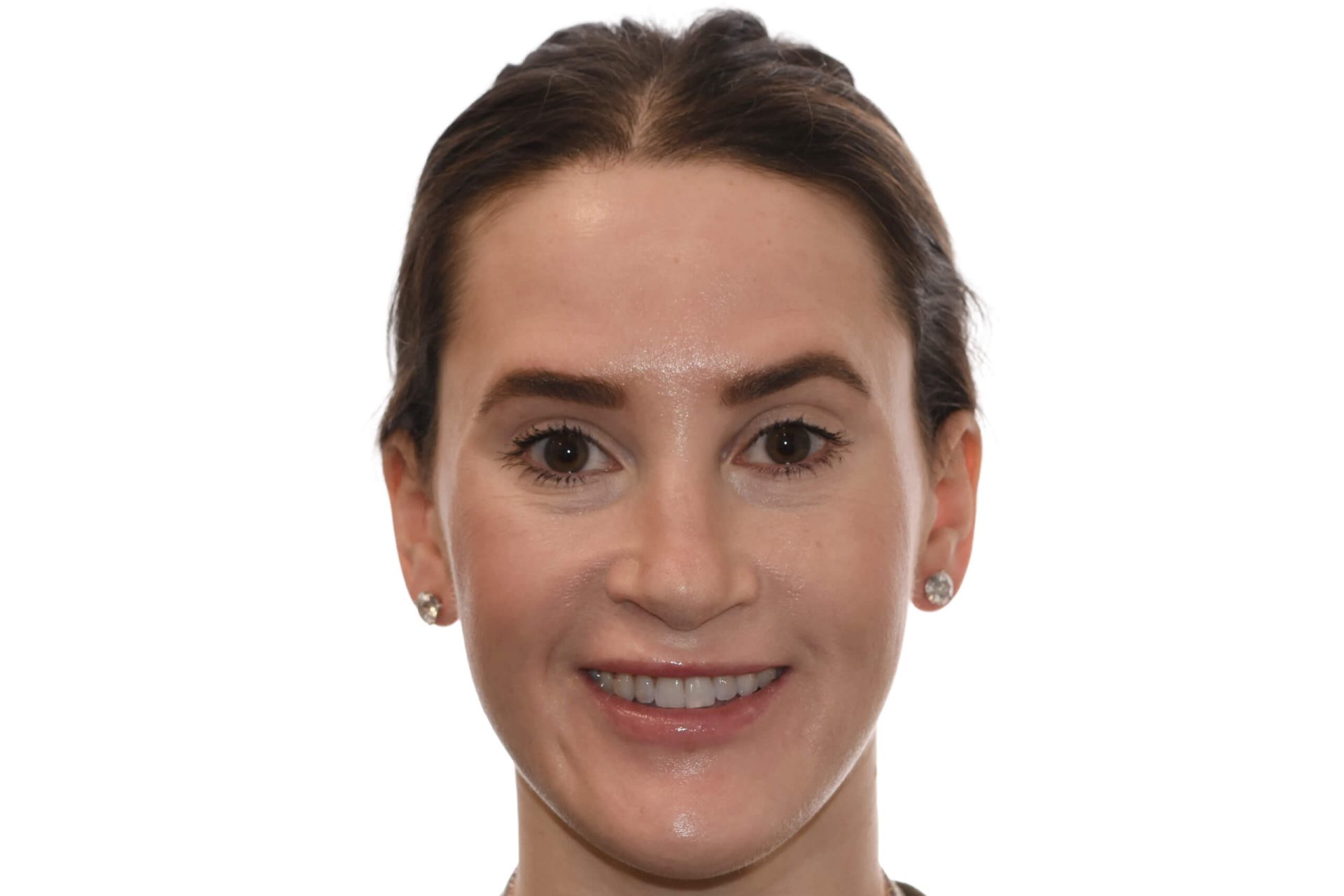 Frontal View After Surgery of a patient treated with prognathism correction at the Jaw Surgery Center of New Jersey.
