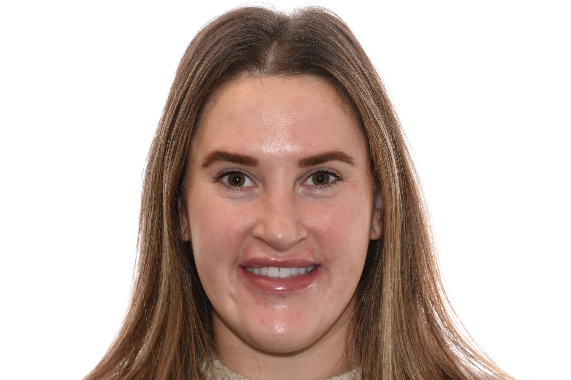 rosoin frontal smiling before-scaled Frontal view of a patient before prognathism correction