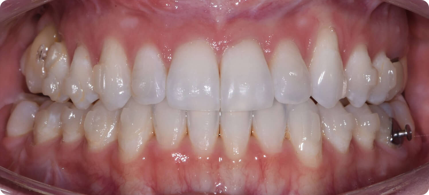 Occlusal View After Surgery of a patient treated with prognathism correction at the Jaw Surgery Center of New Jersey.
