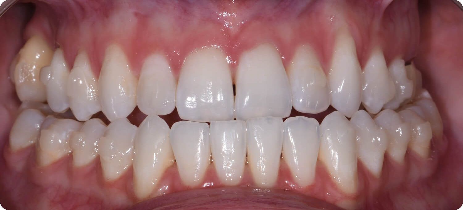 Occlusal View Before Surgery of a patient treated with prognathism correction at the Jaw Surgery Center of New Jersey.