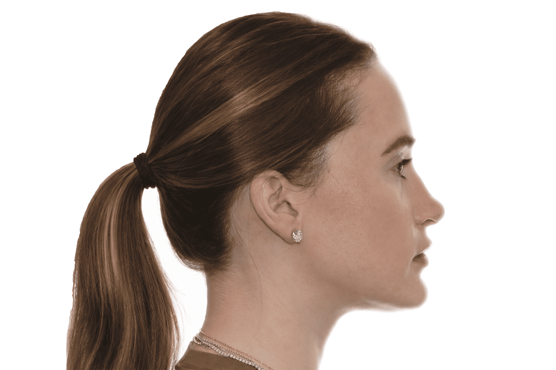 Profile view of a patient after prognathism correction
