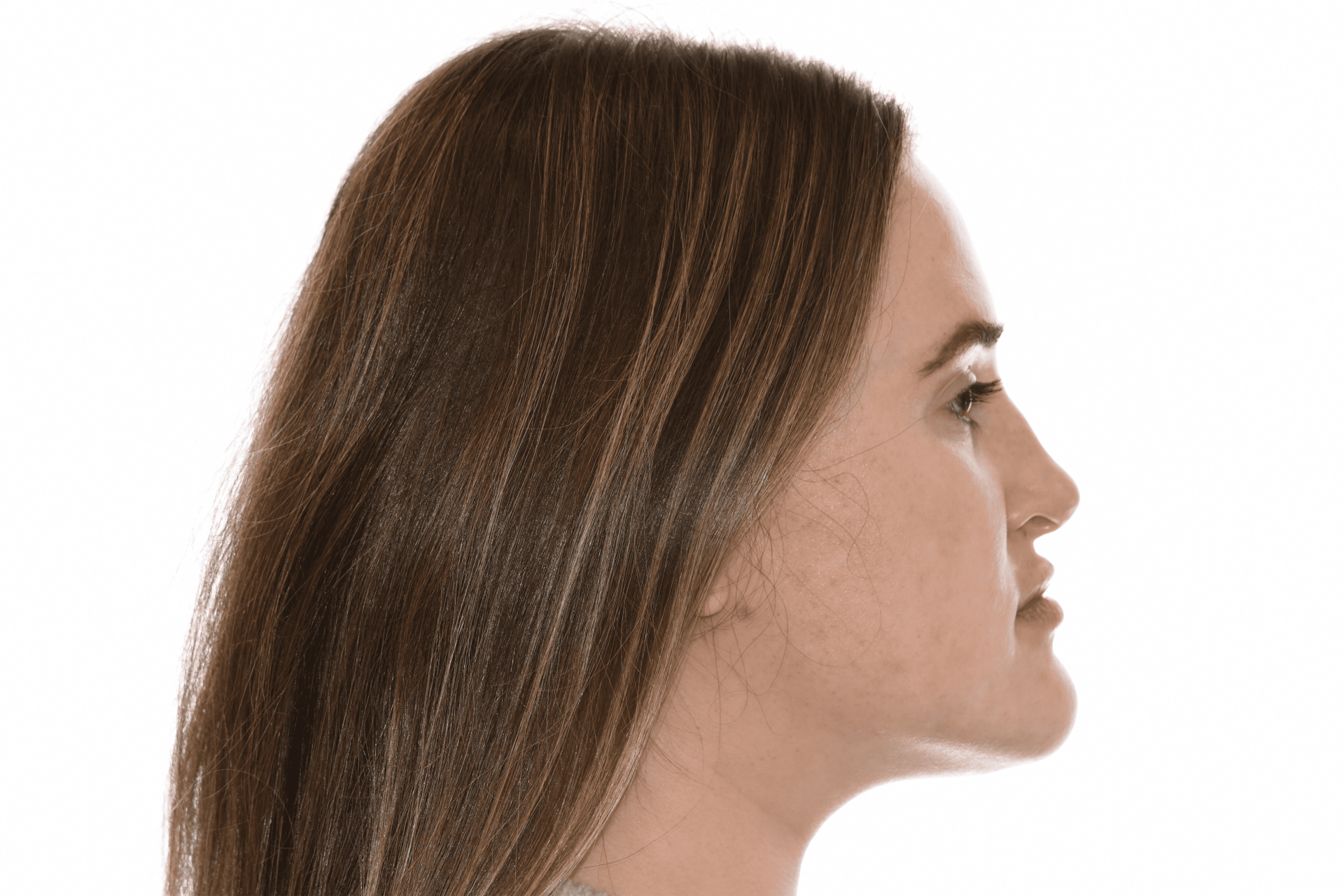 Profile view of a patient before prognathism correction