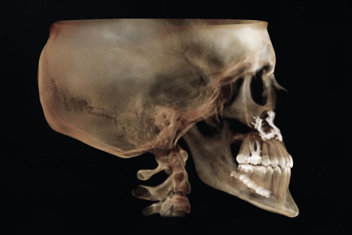 rosin-after-xray-2 X-Ray After Surgery of a patient treated with prognathism correction at the Jaw Surgery Center of New Jersey.