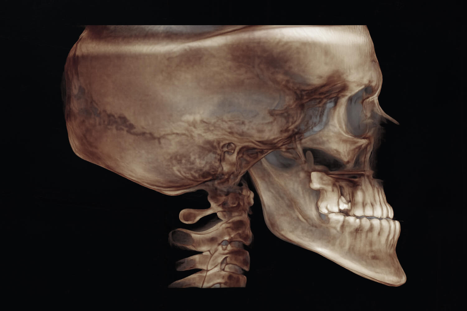 rosin-before-xray X-Ray Before Surgery of a patient treated with prognathism correction at the Jaw Surgery Center of New Jersey.