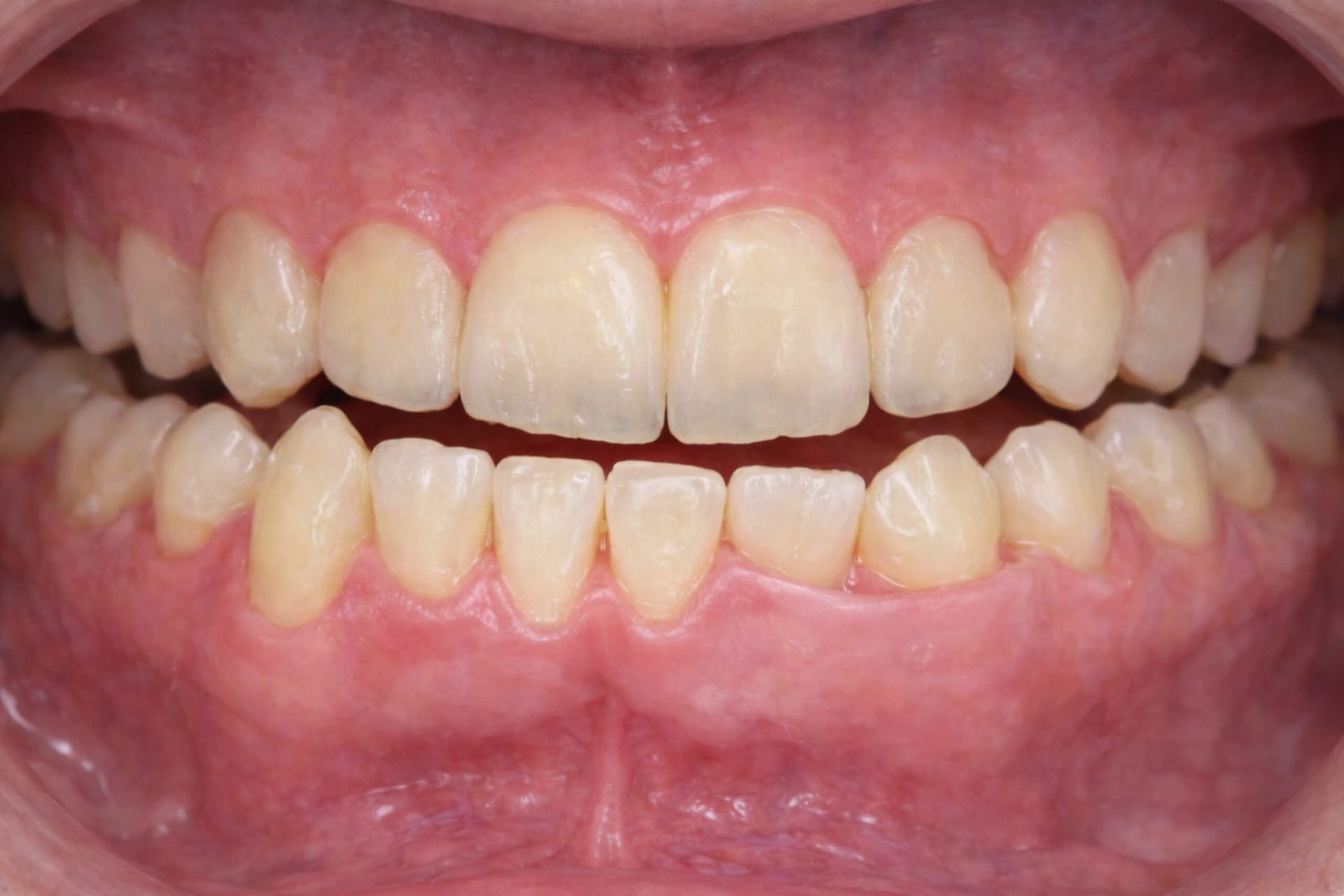 prognathism - occlusal view Clinical presentation of prognathism, occlusal view.