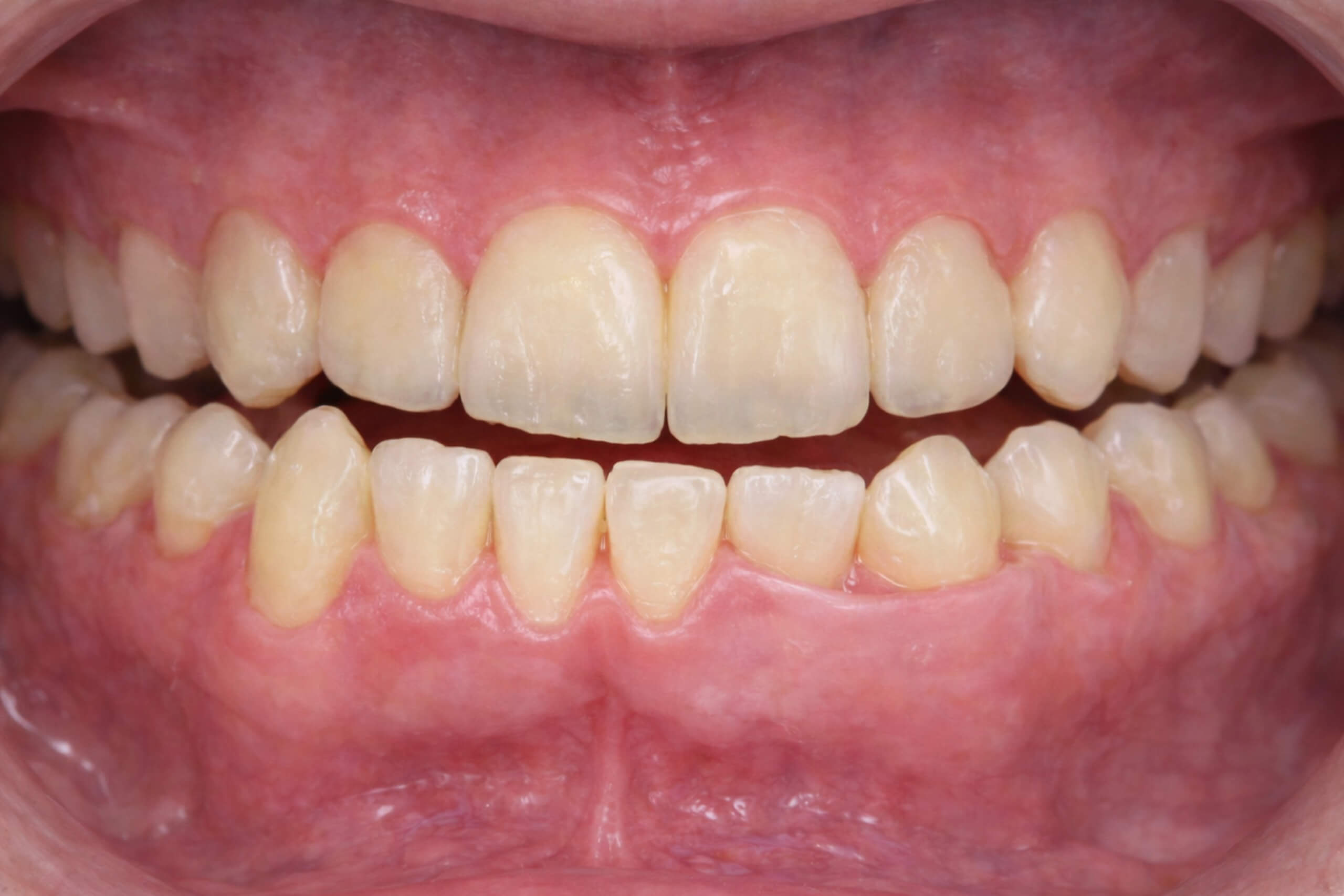 Prognathism Occlusal View