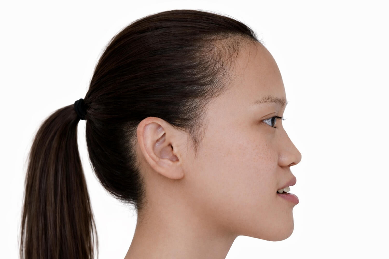 prognathism-profile view-2-scaled Clinical presentation of prognathism, profile view.