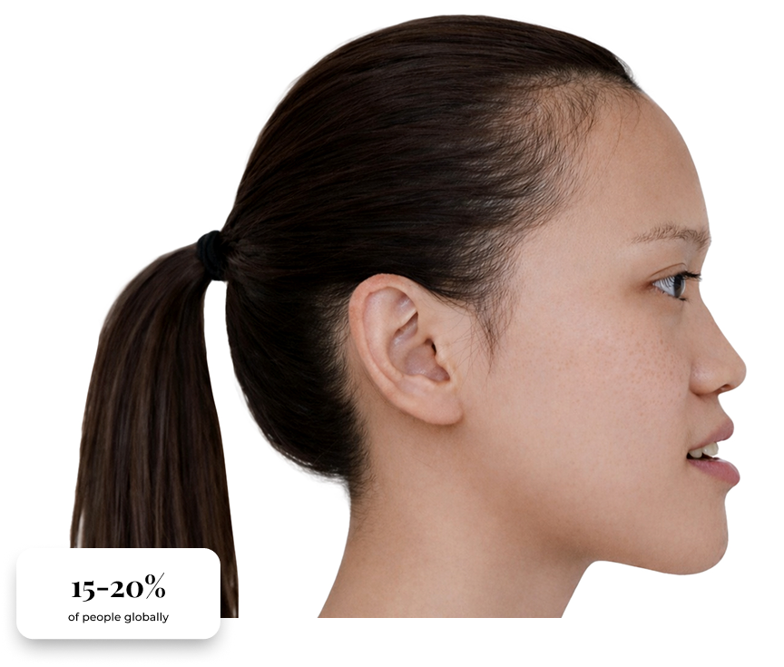 Clinical presentation of prognathism, profile view with statistics.
