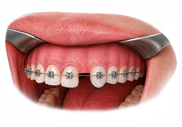 ABG 6 - reframed Illustration of the continuous, restored alveolar ridge after bone grafting.