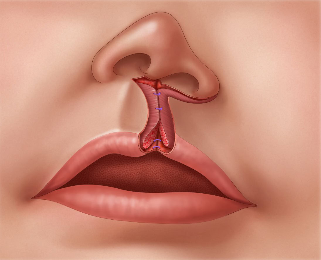 Unilateral-Cleft-Lip-Repair-step-2-3xv2 Illustration of rotation and advancement for unilateral cleft lip repair.