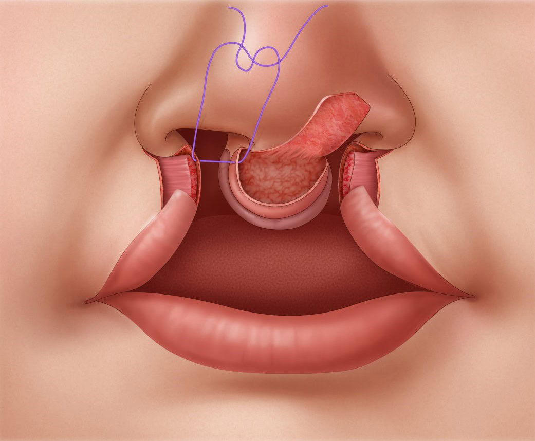 Bilateral-Cleft-Lip-Repair-step-3v2 Illustration of suturing around the central lip segment in bilateral cleft lip repair.