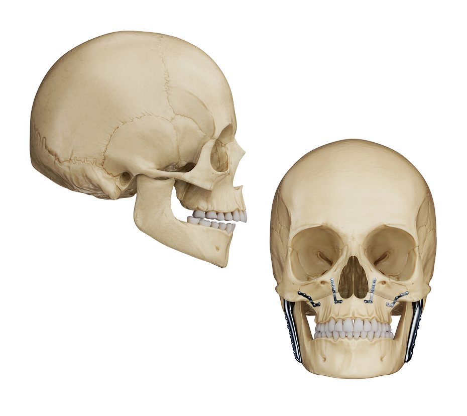 TMJ Joint Replacement Illustration
