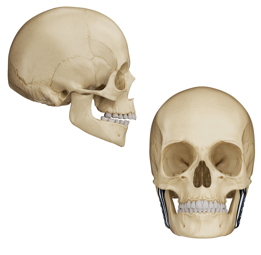 Illustration of a total TMJ joint replacement prosthesis.