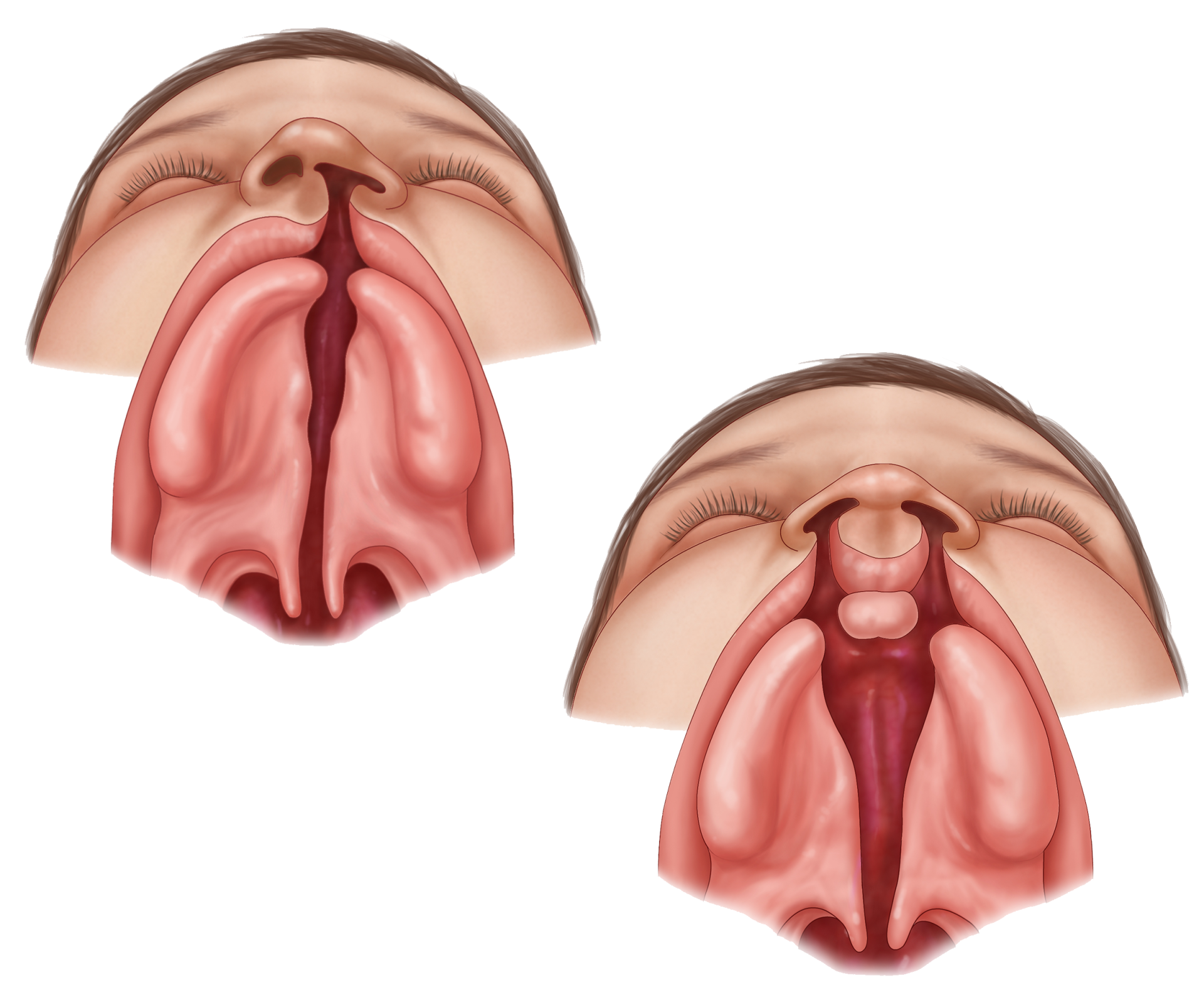 Illustration of normal and cleft palate in children for medical understanding.