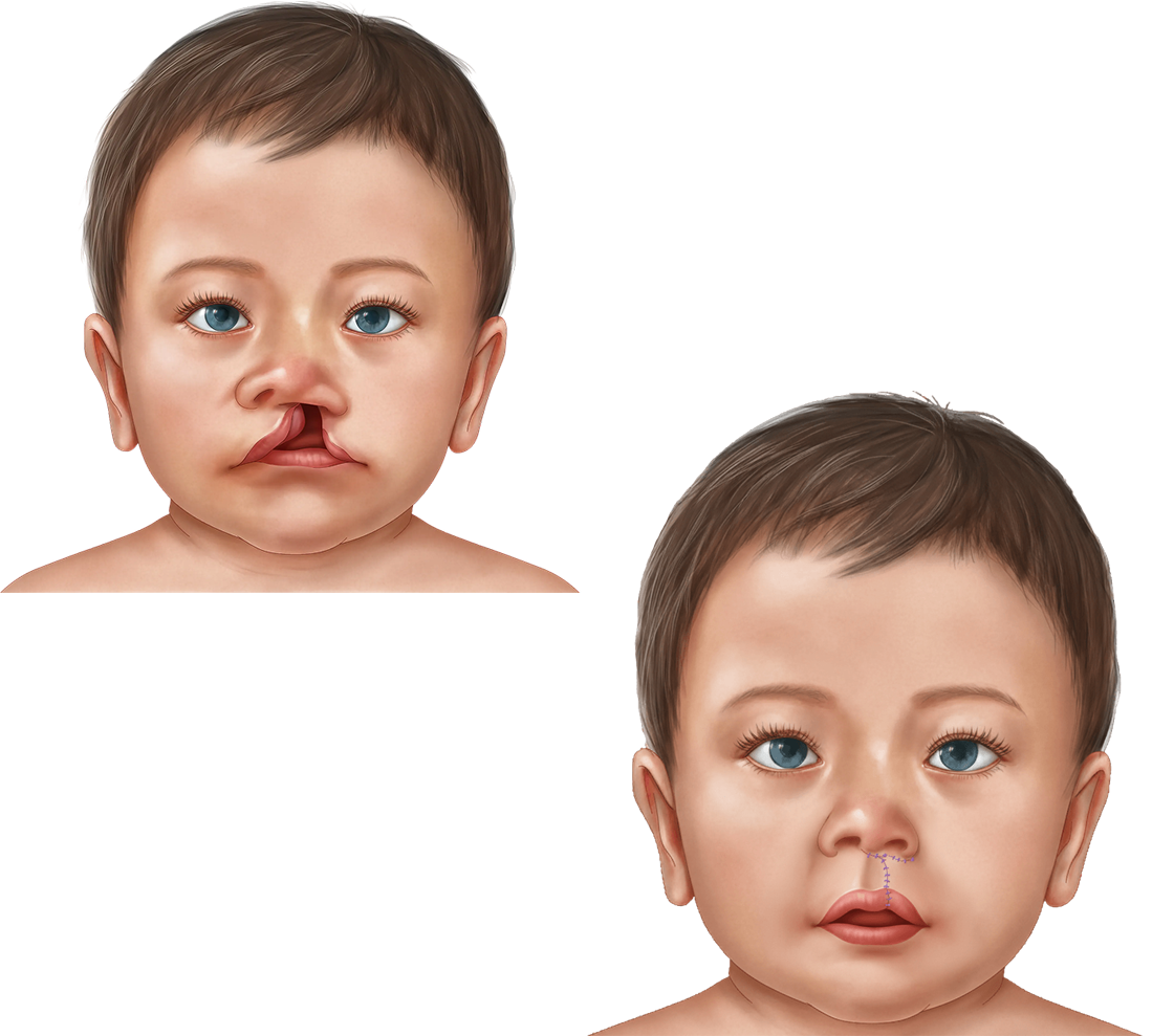 Before and after illustration of unilateral cleft lip repair.