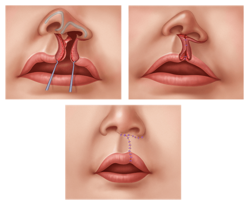 Illustration of a unilateral cleft lip repair.