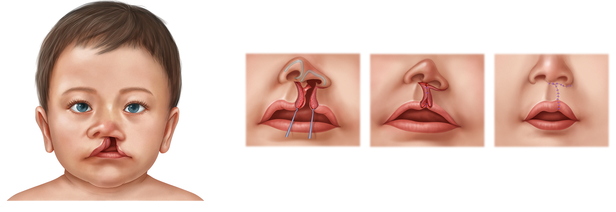 Unilateral Cleft Lip Repair