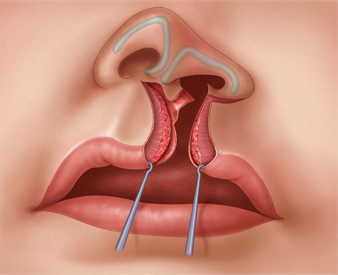 Unilateral-Cleft-Lip-Repair-step-1-3xv2 Illustration of a one-sided cleft orbicularis oris muscle.