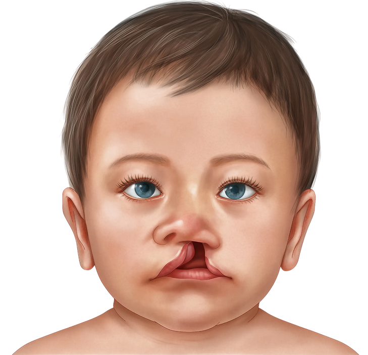 Unilateral Complete Cleft Lip Illustration