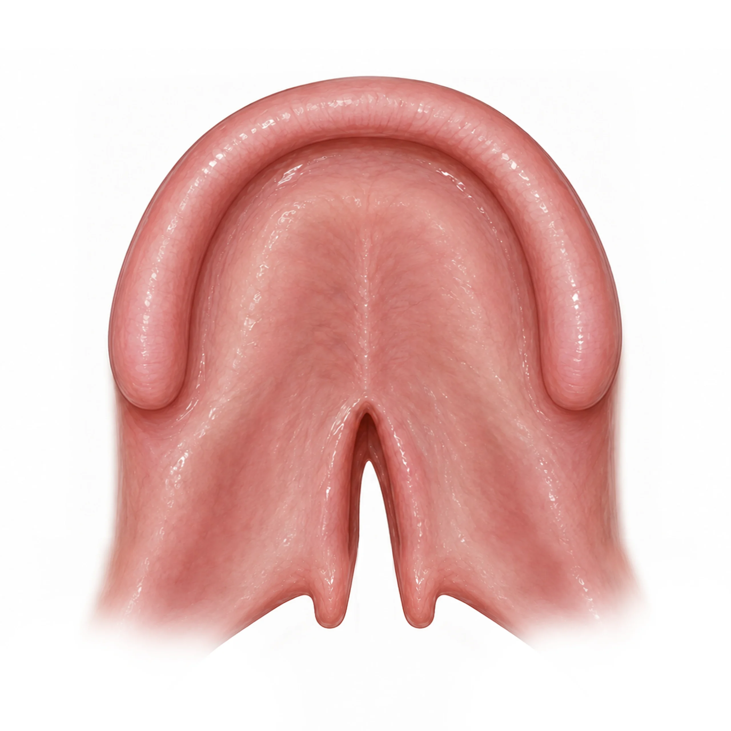 Illustration of a Veau class I cleft limited to the soft palate.