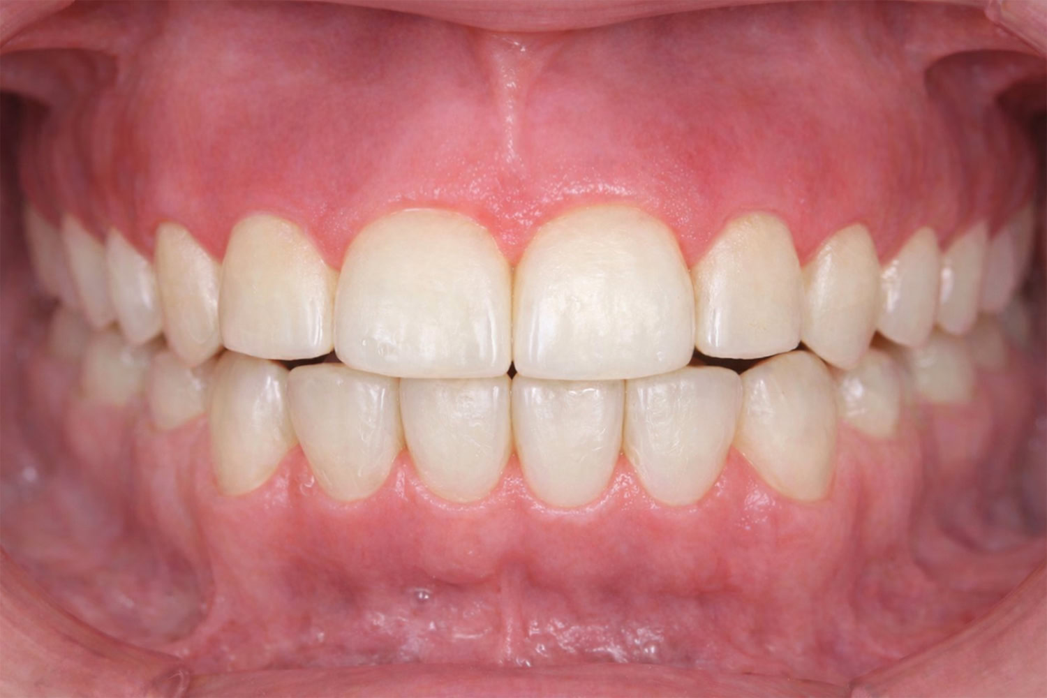 vertical-maxillary-excess-occlusal Clinical presentation of vertical maxillary excess, occlusal view.