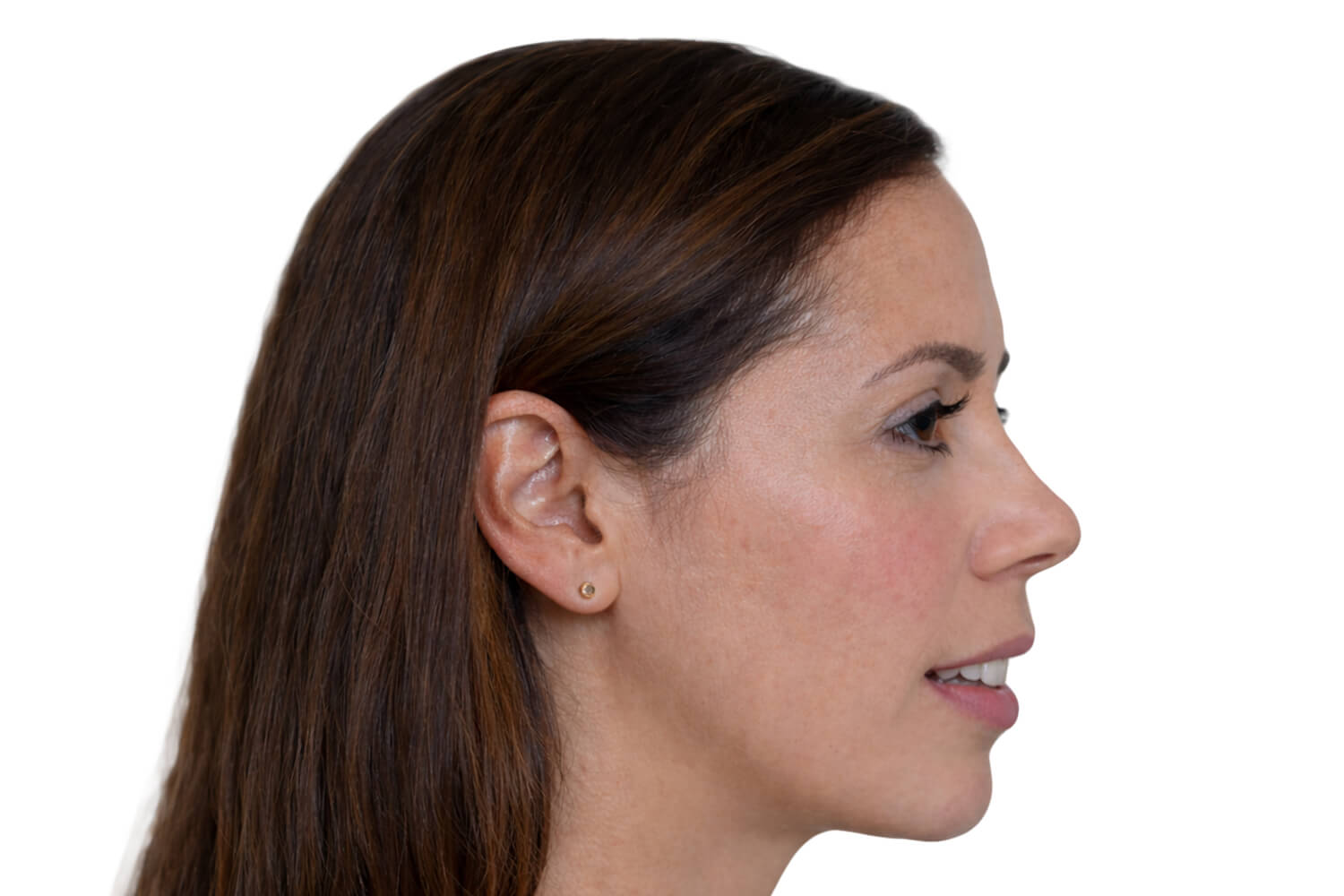 vertical-maxillary-excess-profile-scaled Clinical presentation of vertical maxillary excess, profile view.