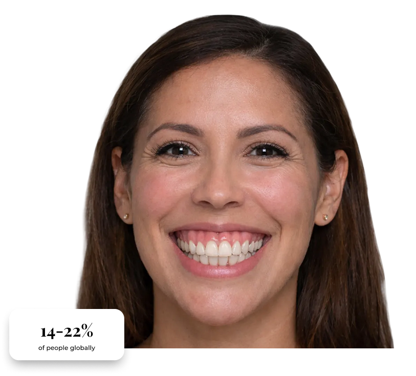 Clinical presentation of vertical maxillary excess, with stats.