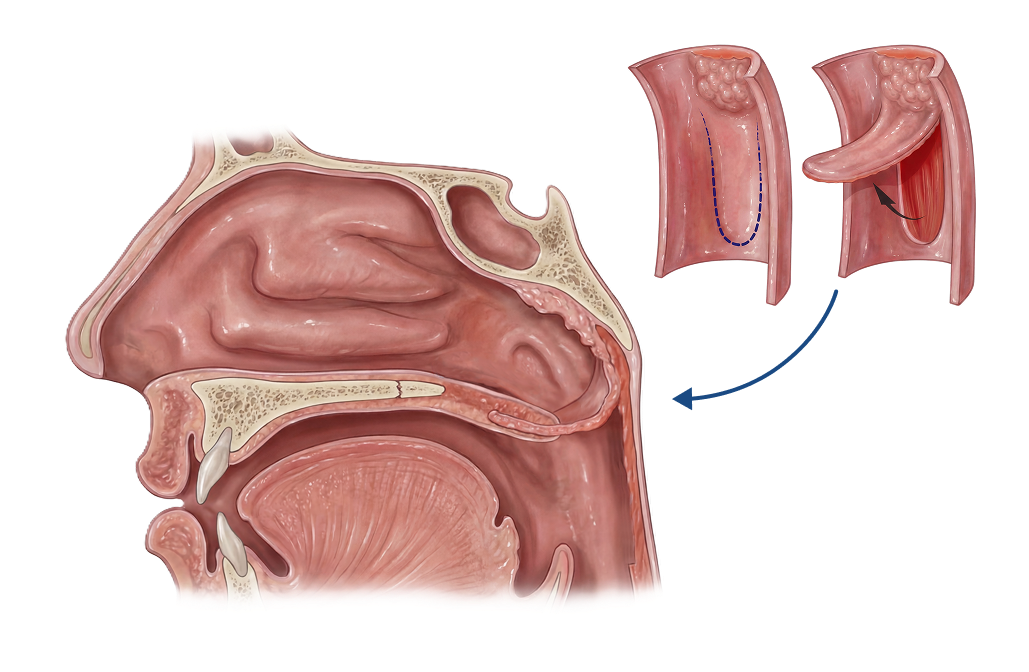 Illustration of a velopharyngeal insufficiency correction procedure.